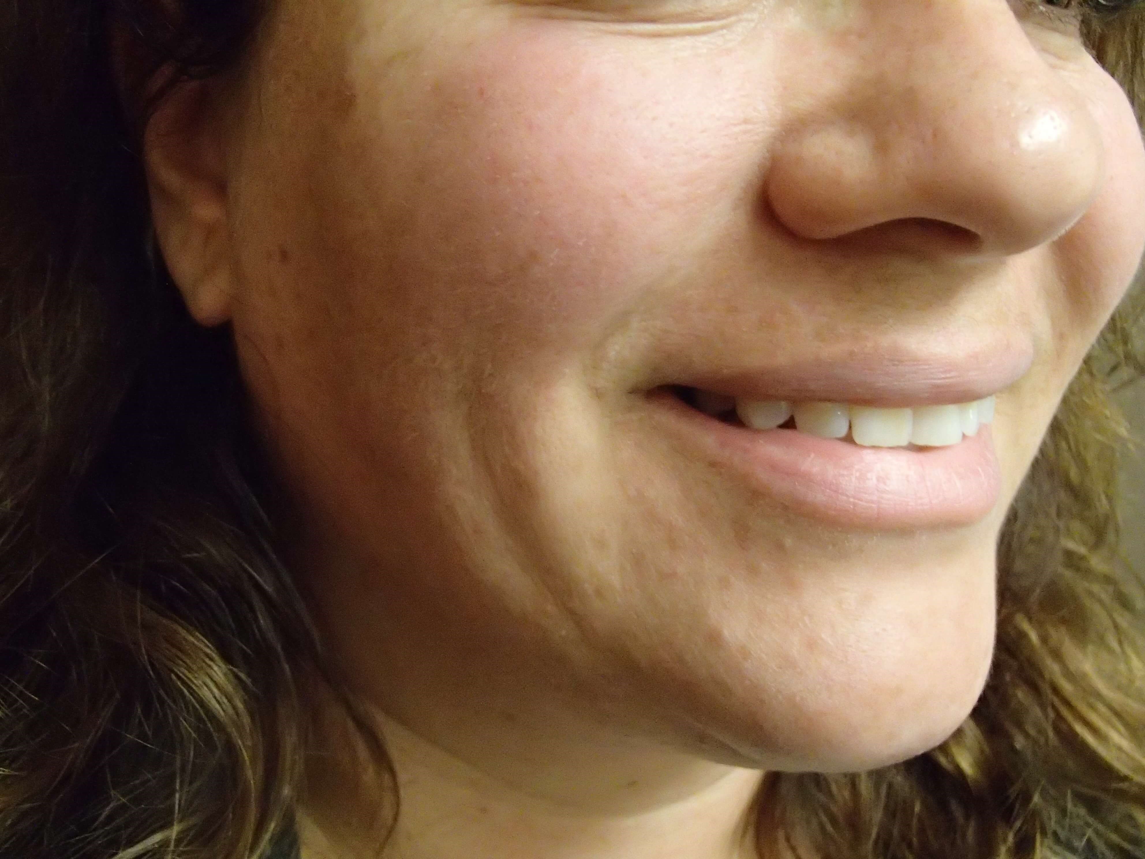 Timeless Dimple Before