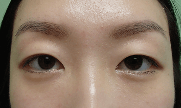 Blepharoplasty Before