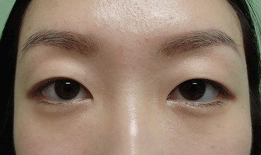 Blepharoplasty Before