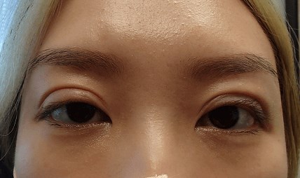 Blepharoplasty After