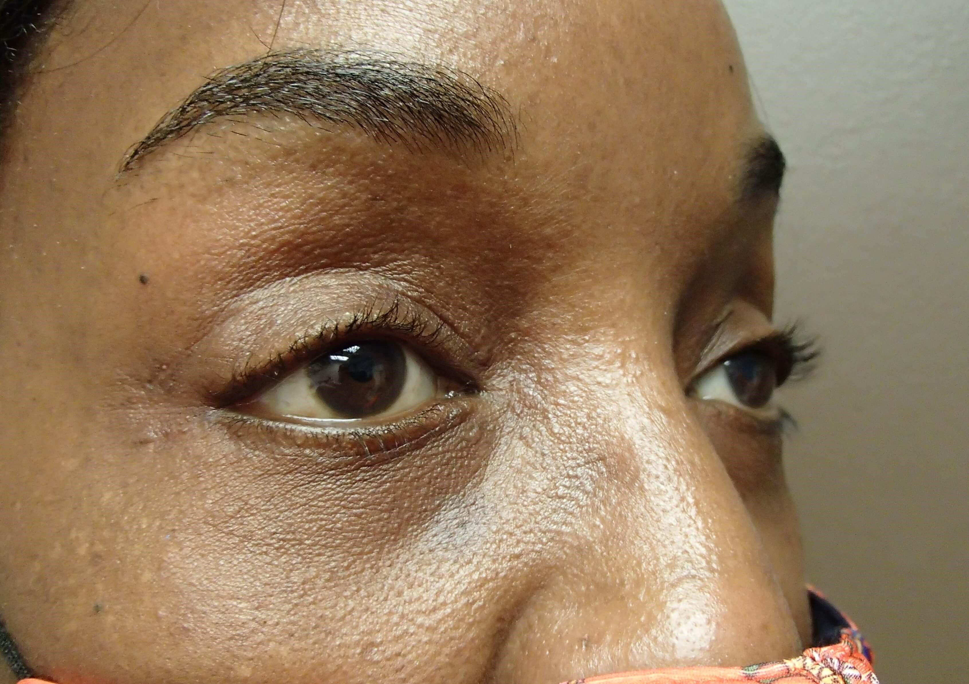 Blepharoplasty After