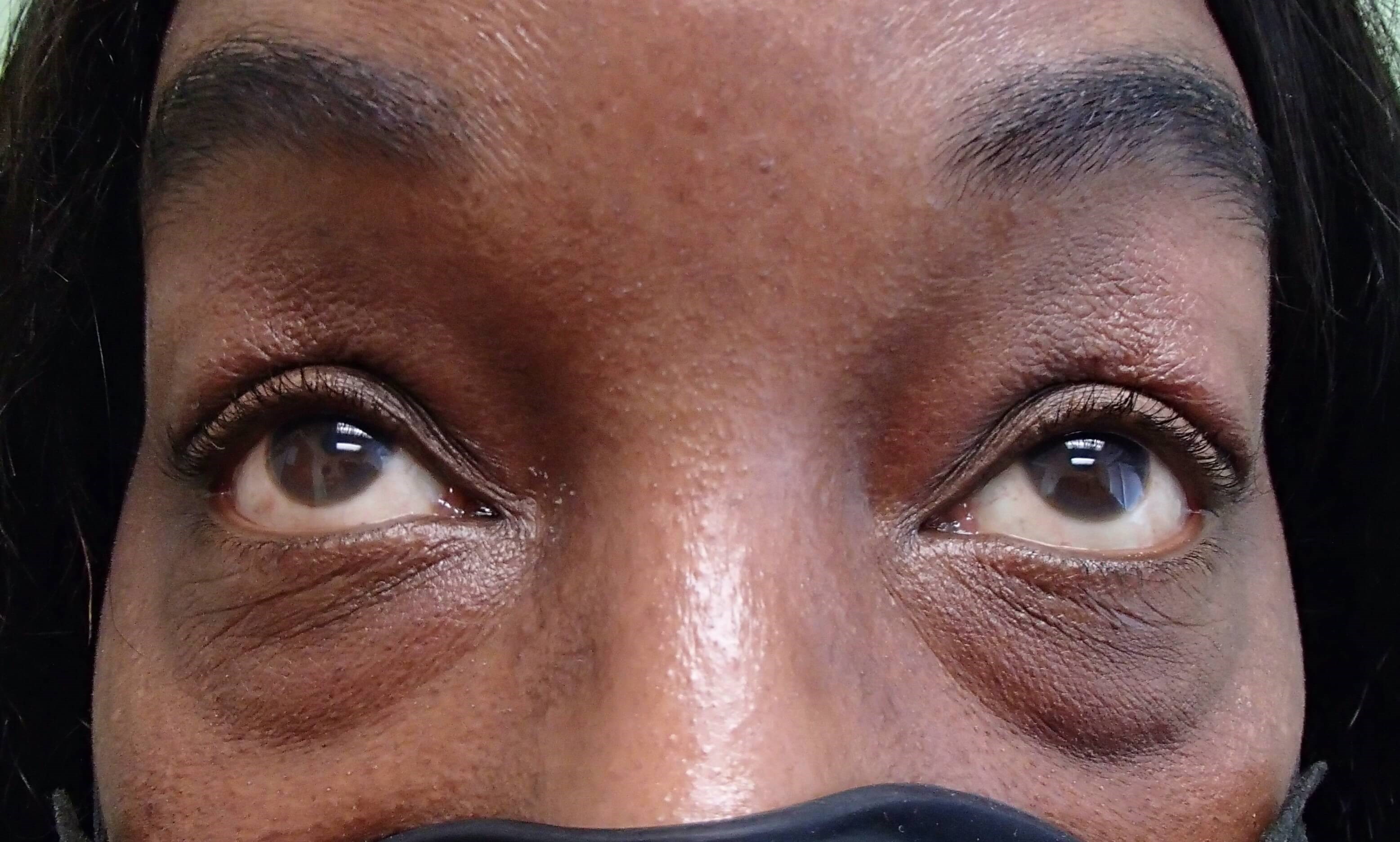 Blepharoplasty Before