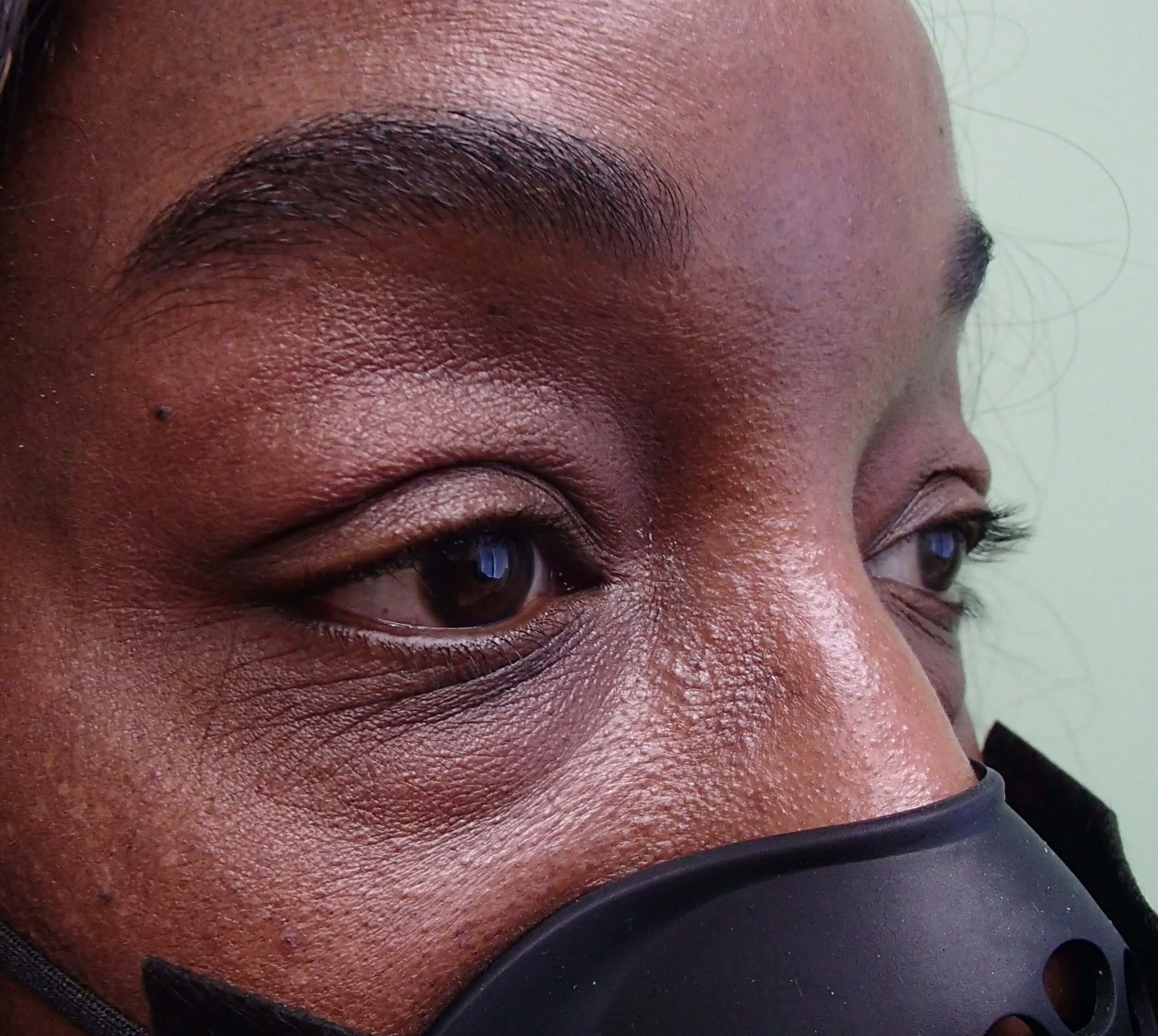 Blepharoplasty Before