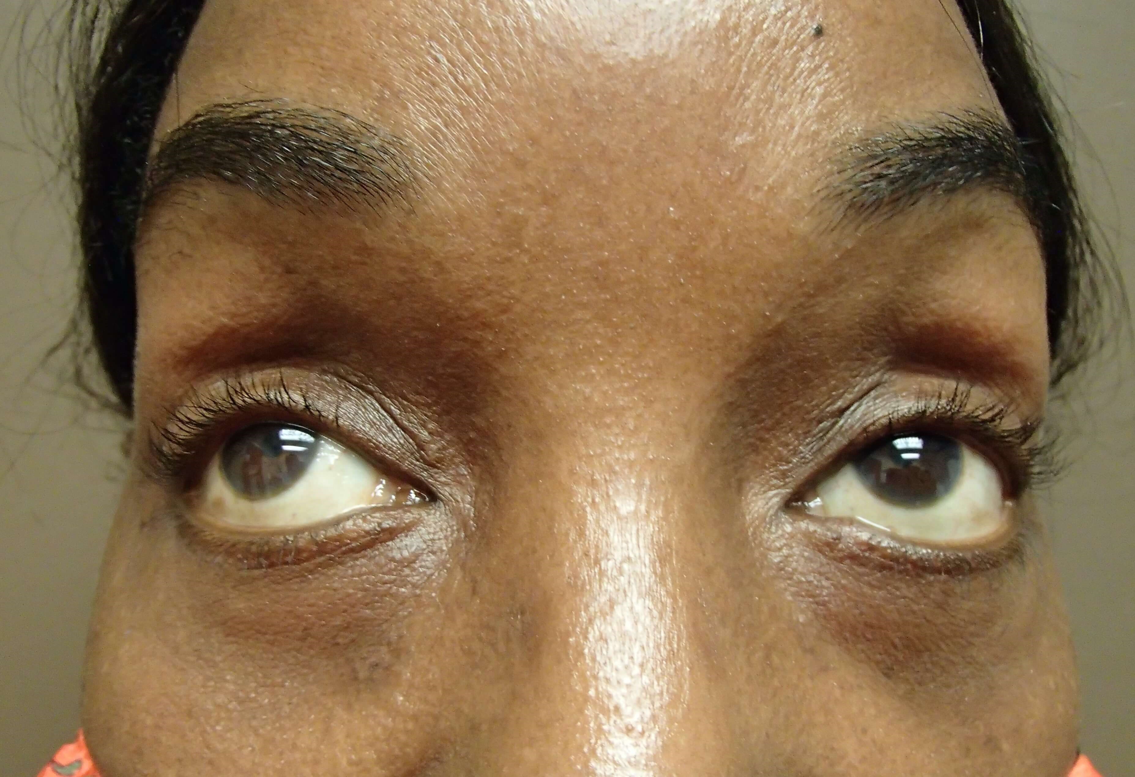 Blepharoplasty After