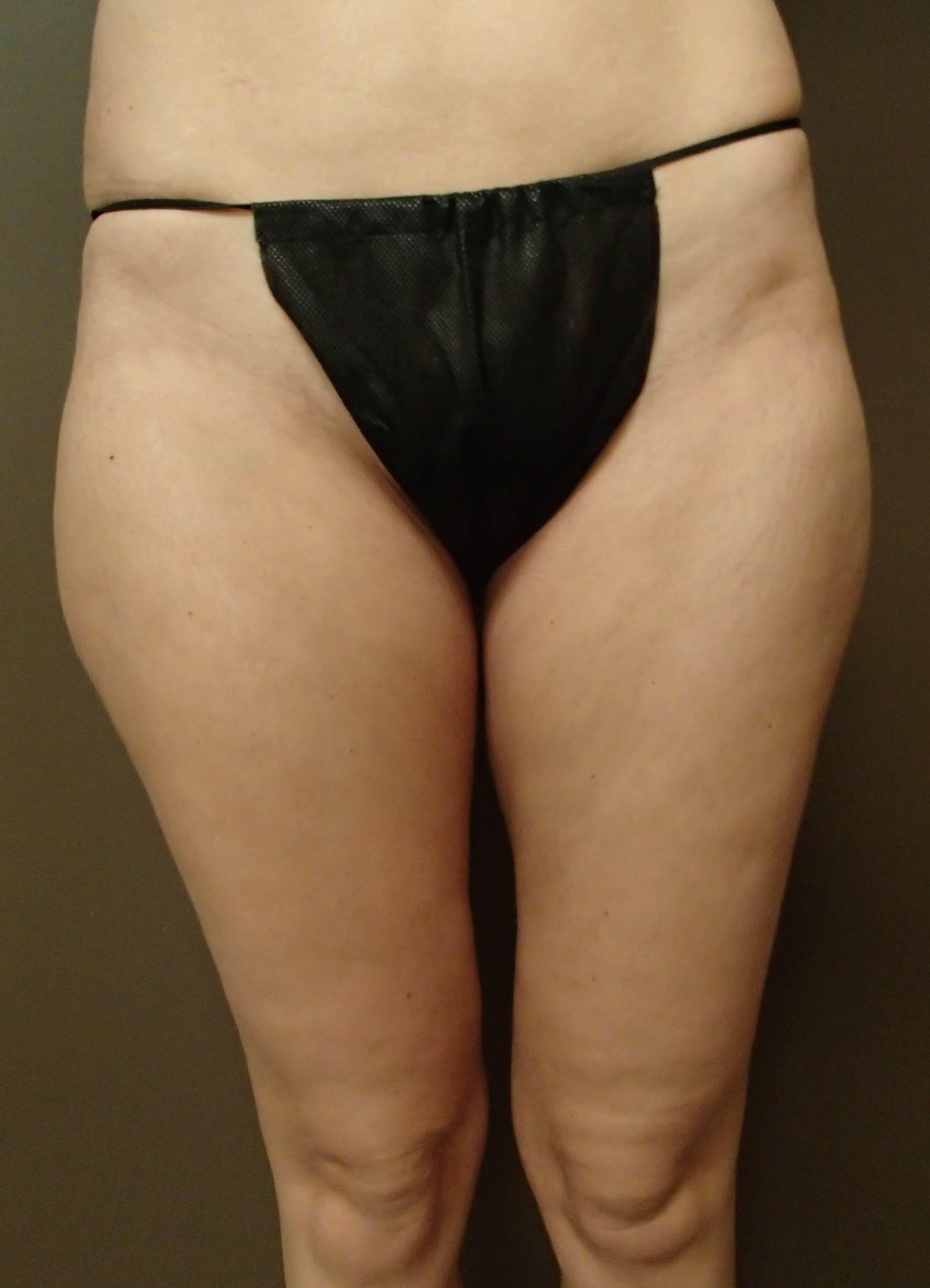 Liposuction Before