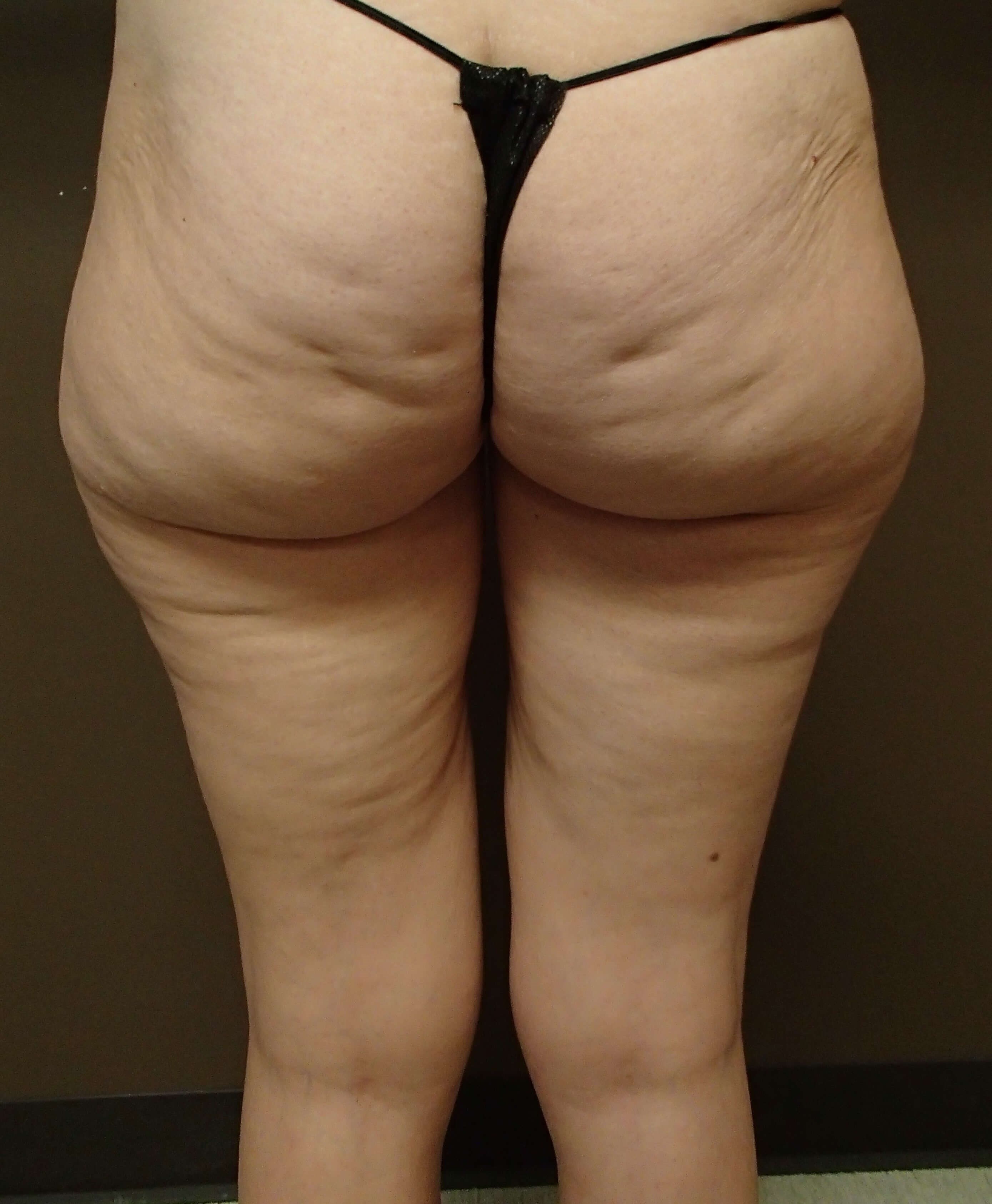 Liposuction Before