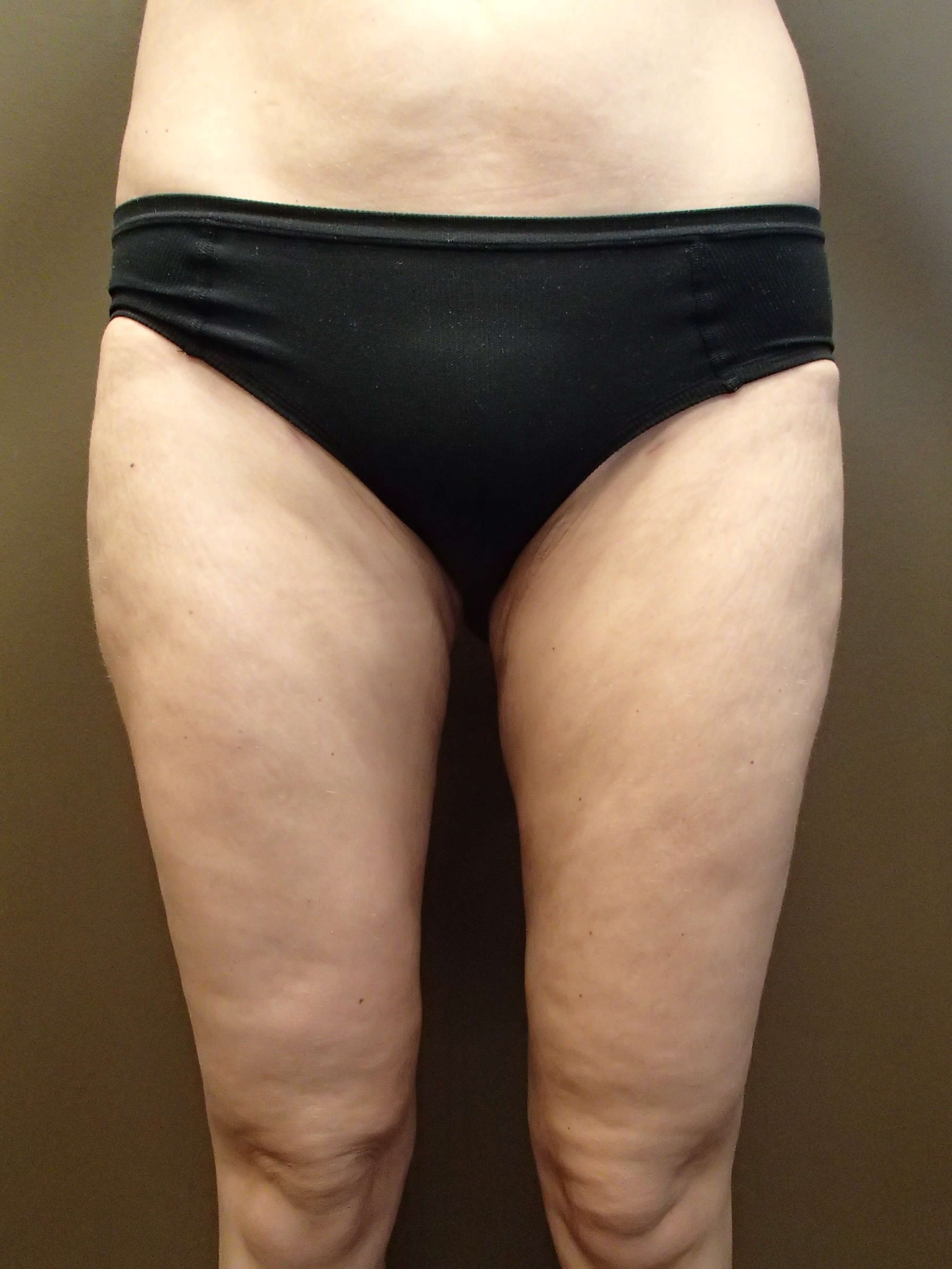 Liposuction After