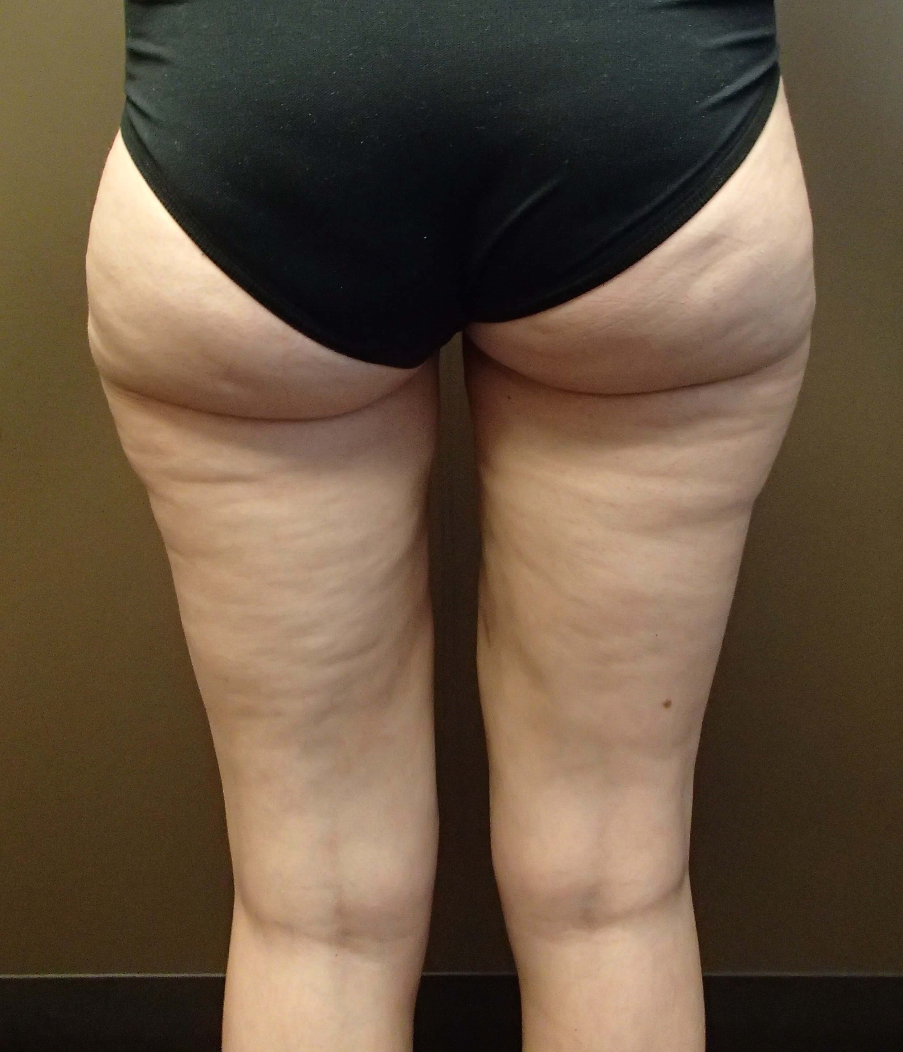 Liposuction After