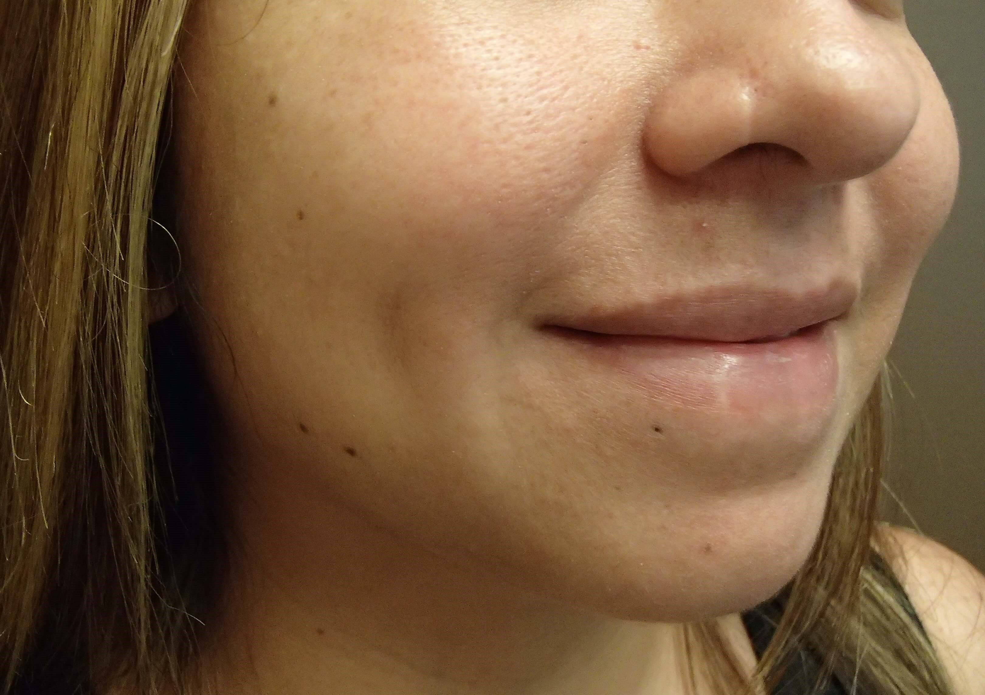 Timeless Dimple (Dimpleplasty) After