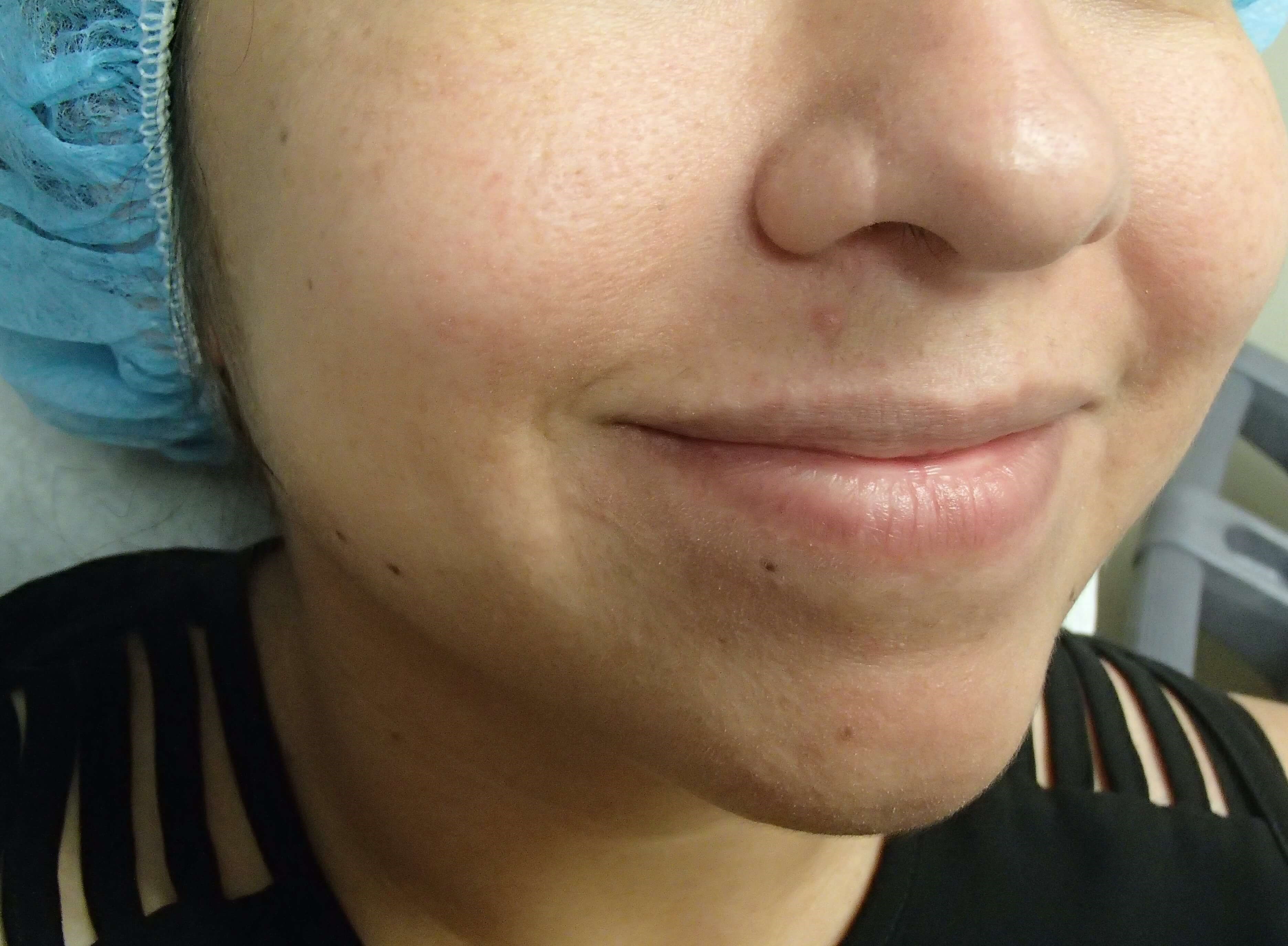 Timeless Dimple (Dimpleplasty) Before