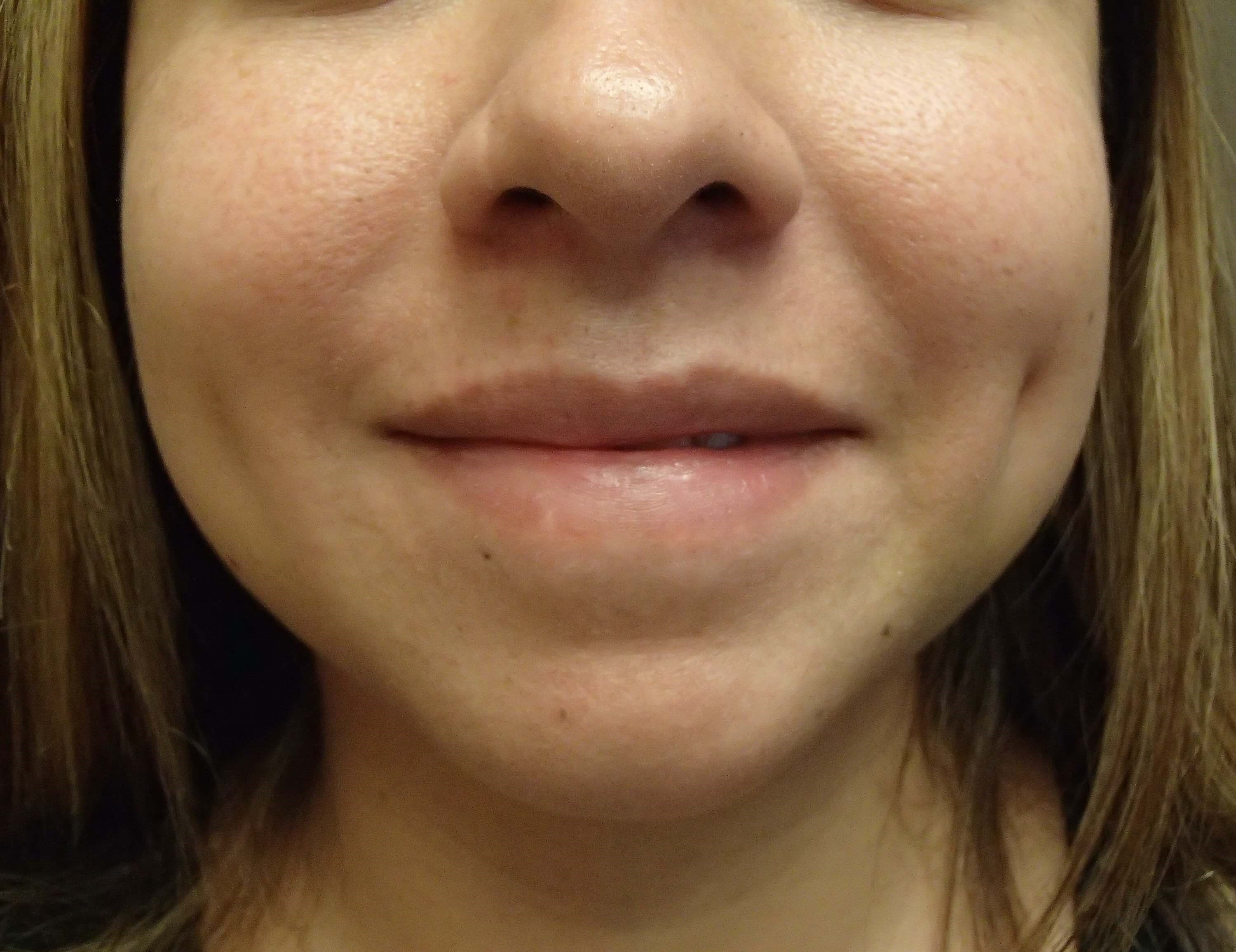 Timeless Dimple (Dimpleplasty) After