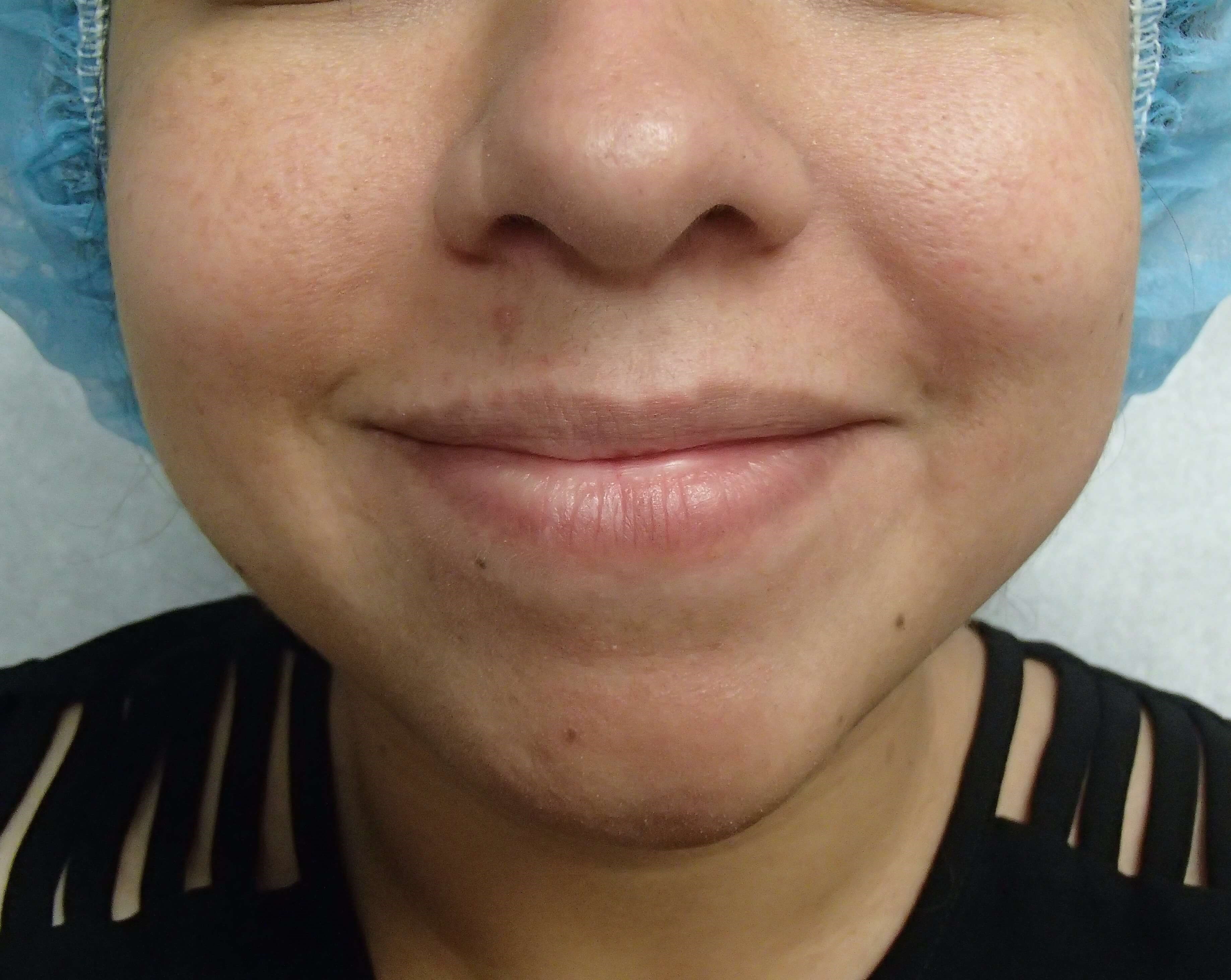 Timeless Dimple (Dimpleplasty) Before