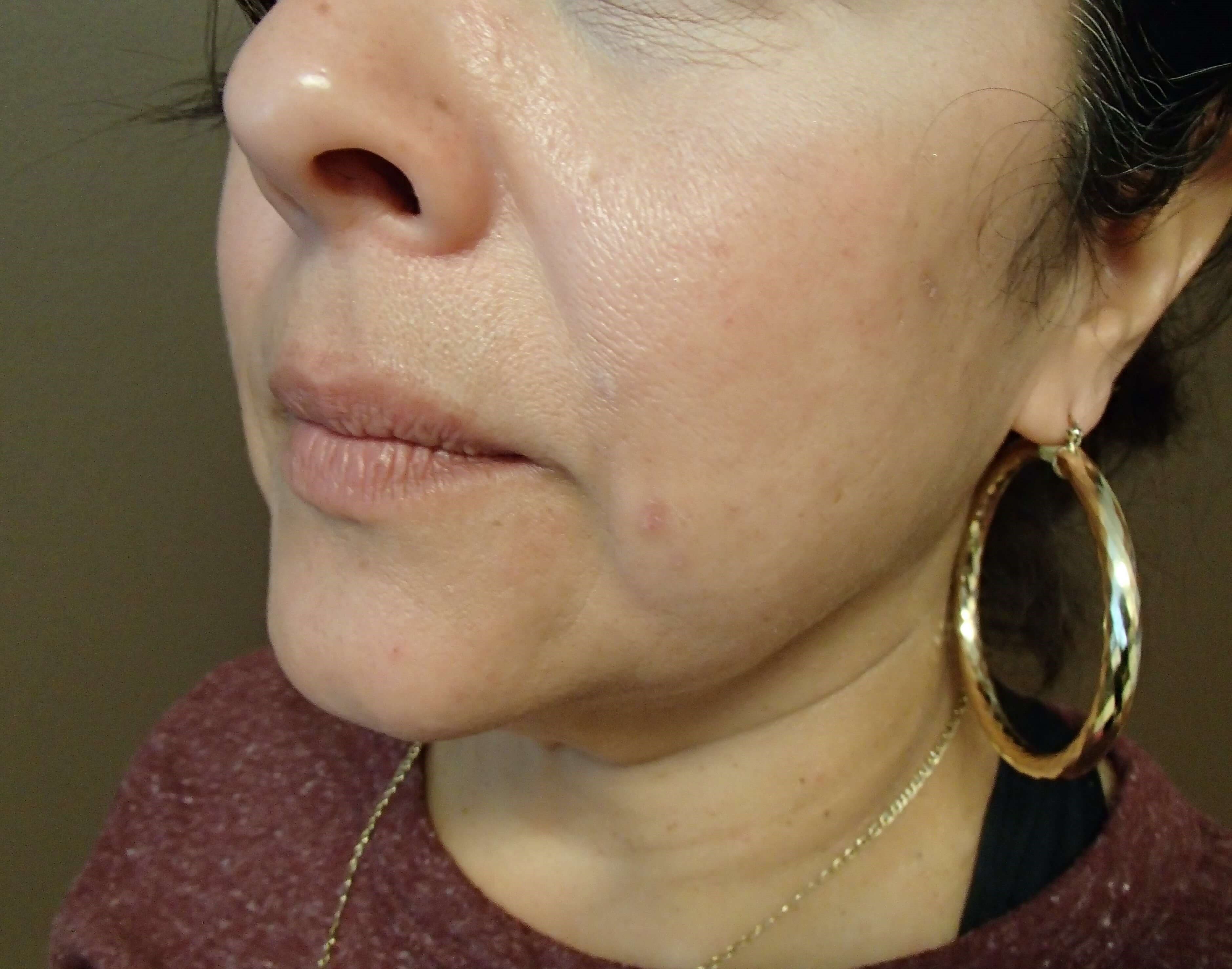 Neck Lift Before