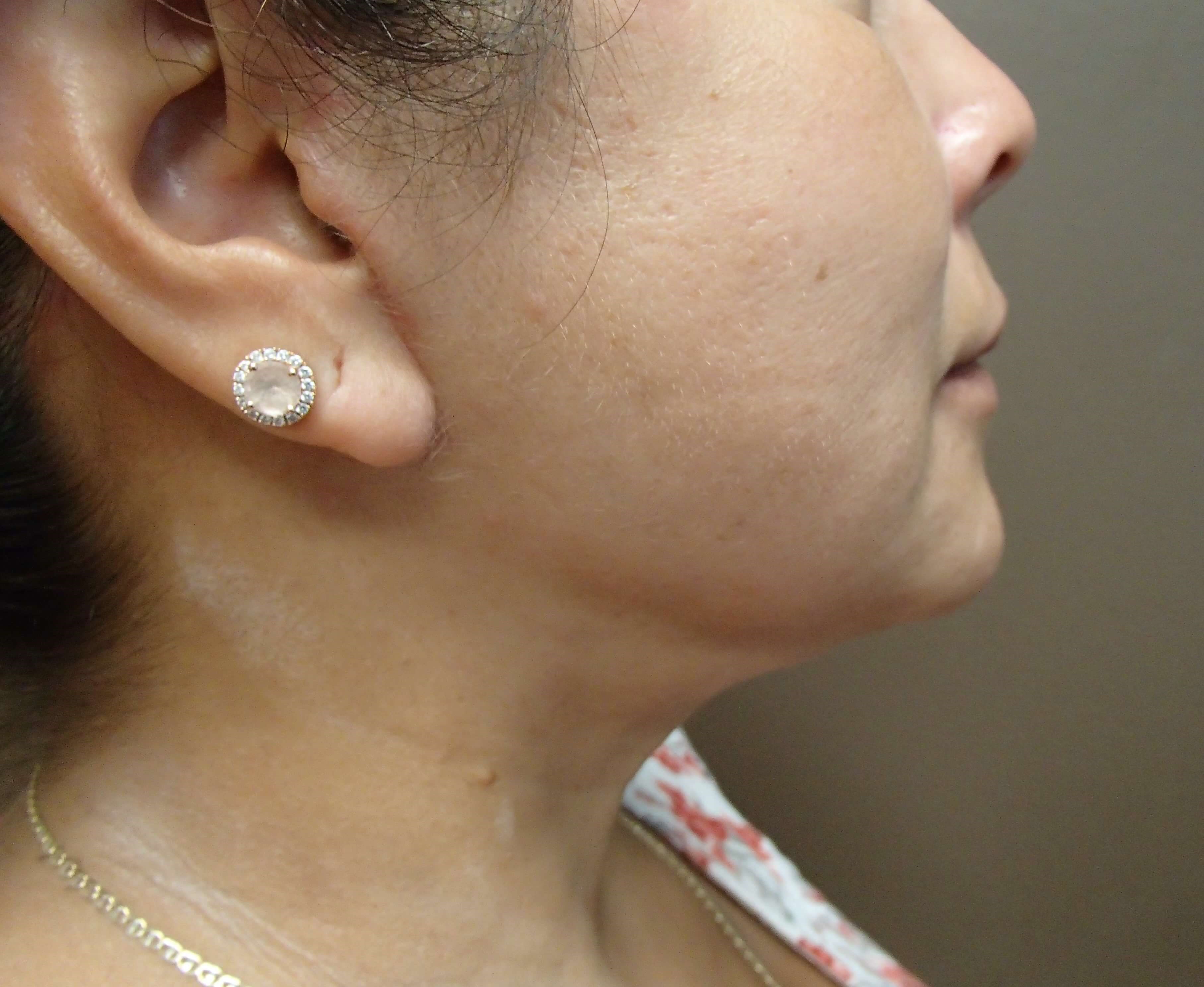 Neck Lift After