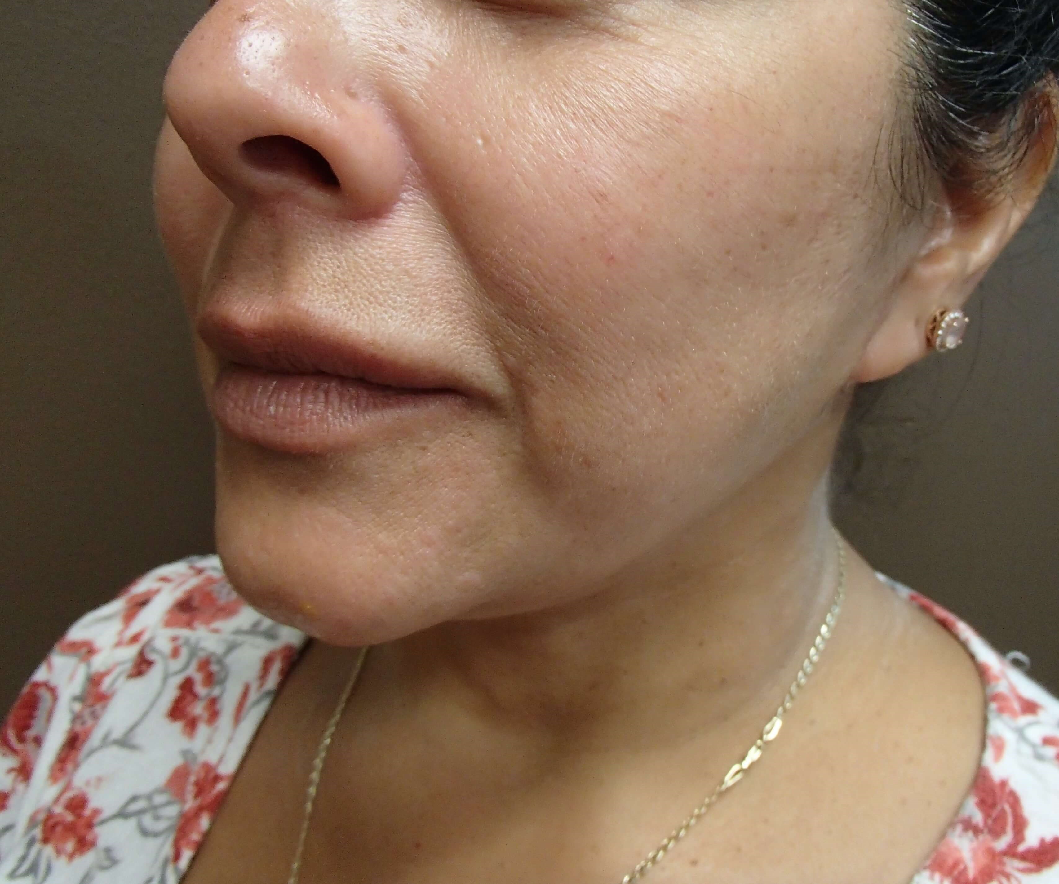 Neck Lift After