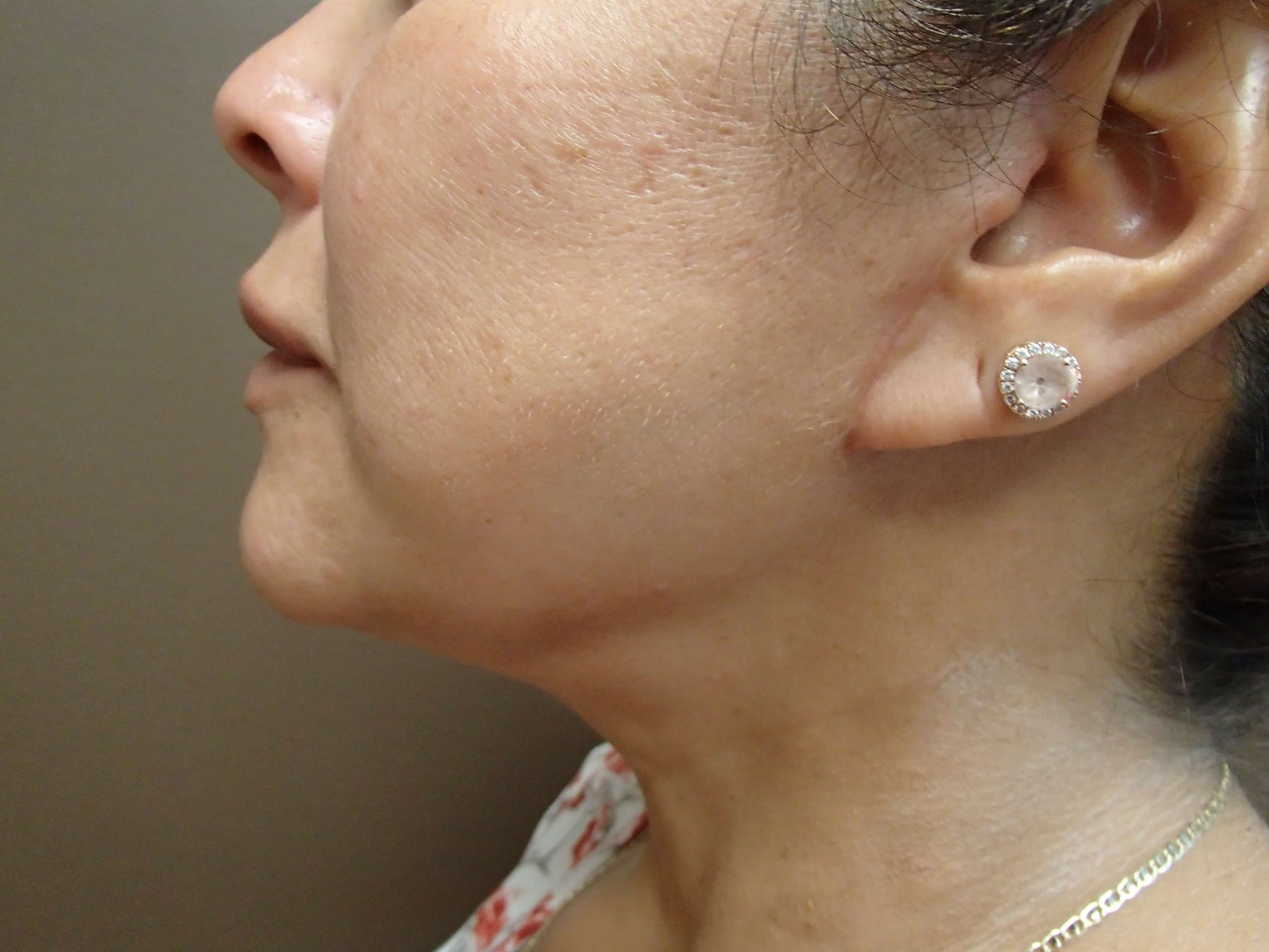 Neck Lift After