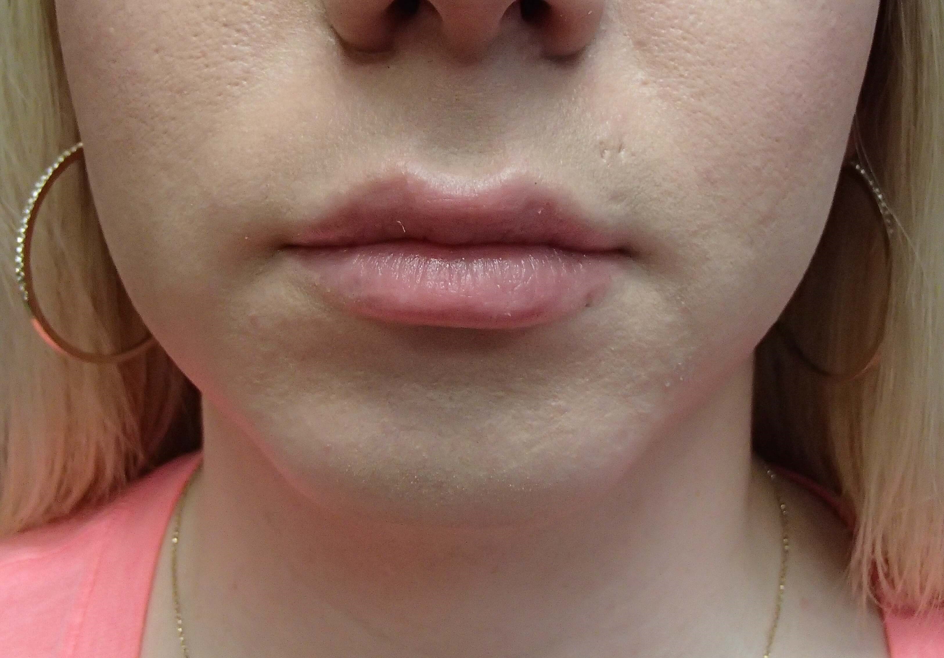 Chin Augmentation Before