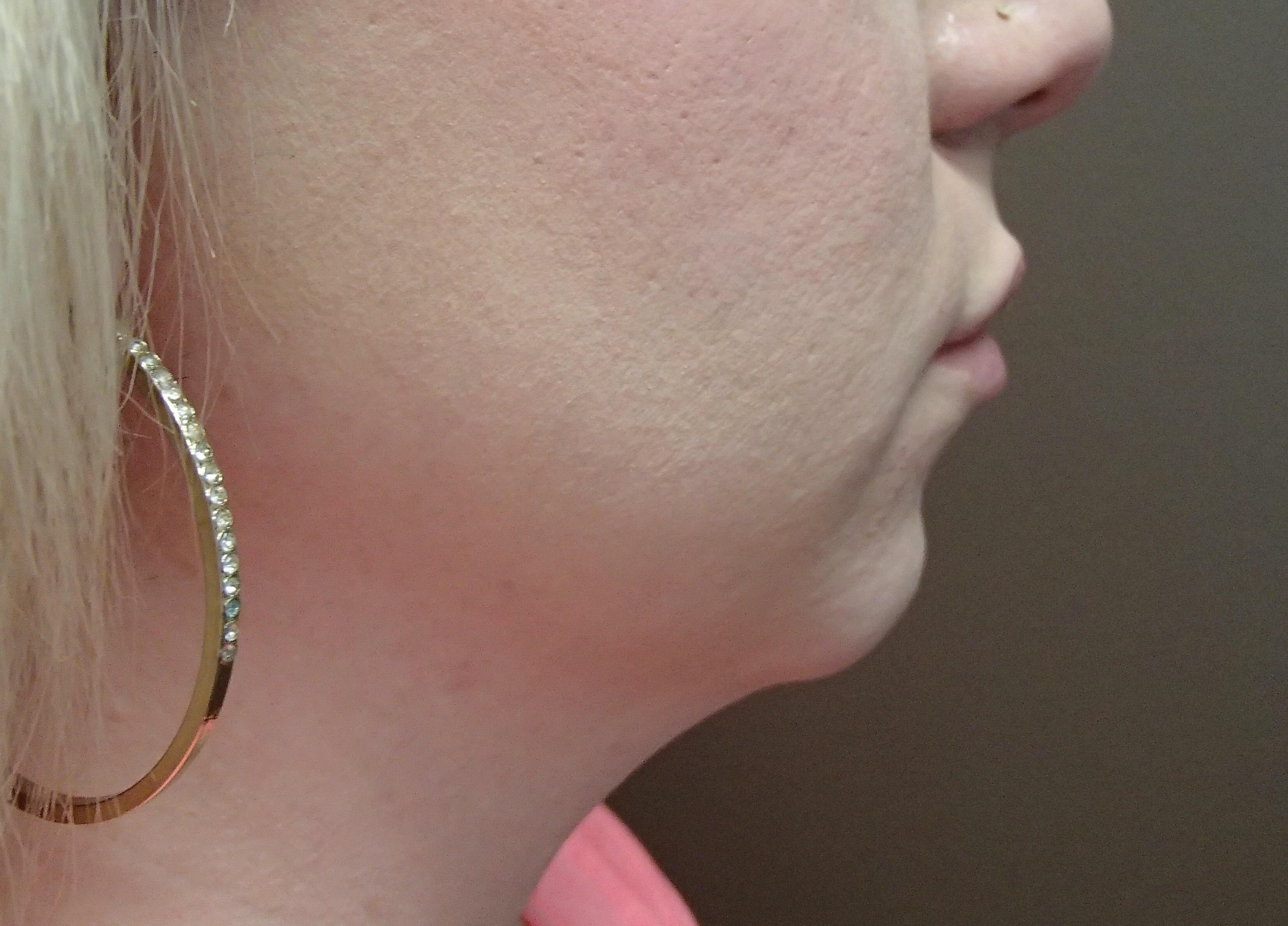 Chin Augmentation Before