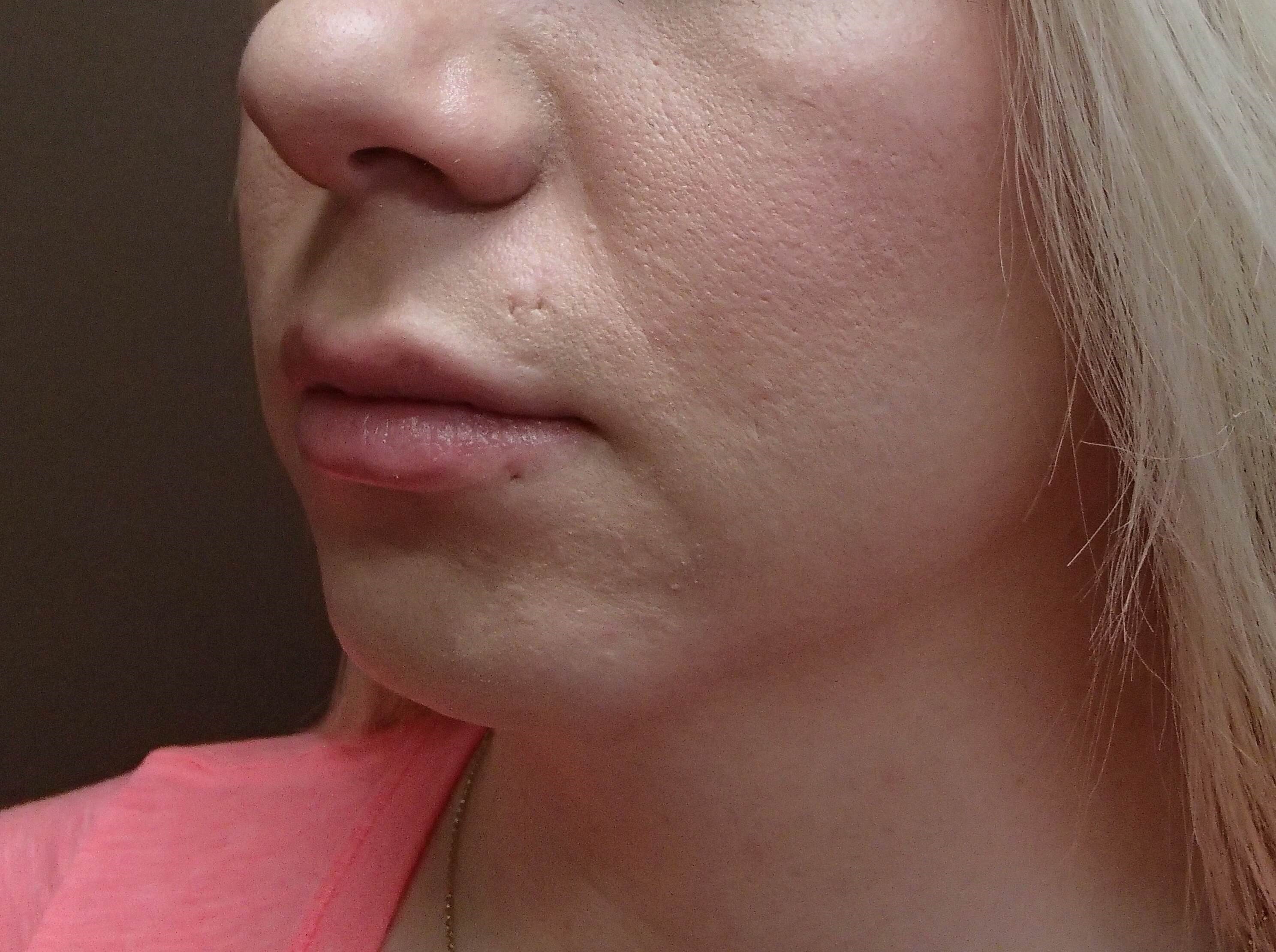 Chin Augmentation Before