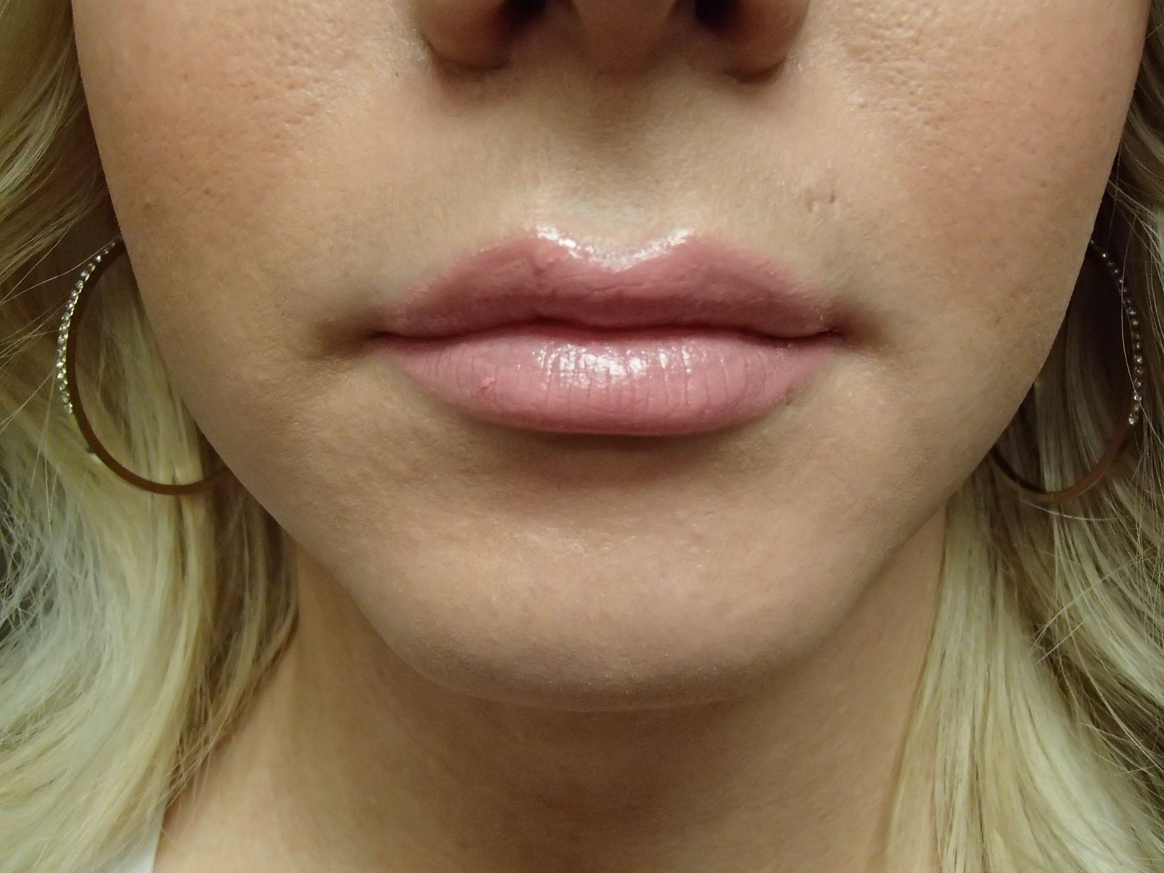 Chin Augmentation After
