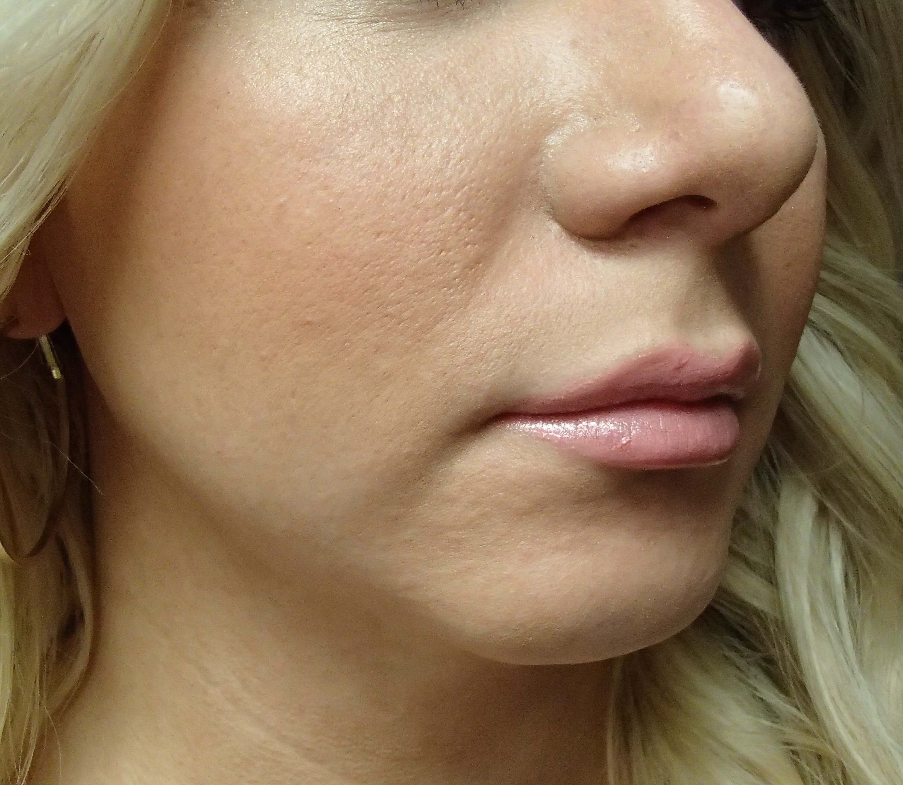 Chin Augmentation After