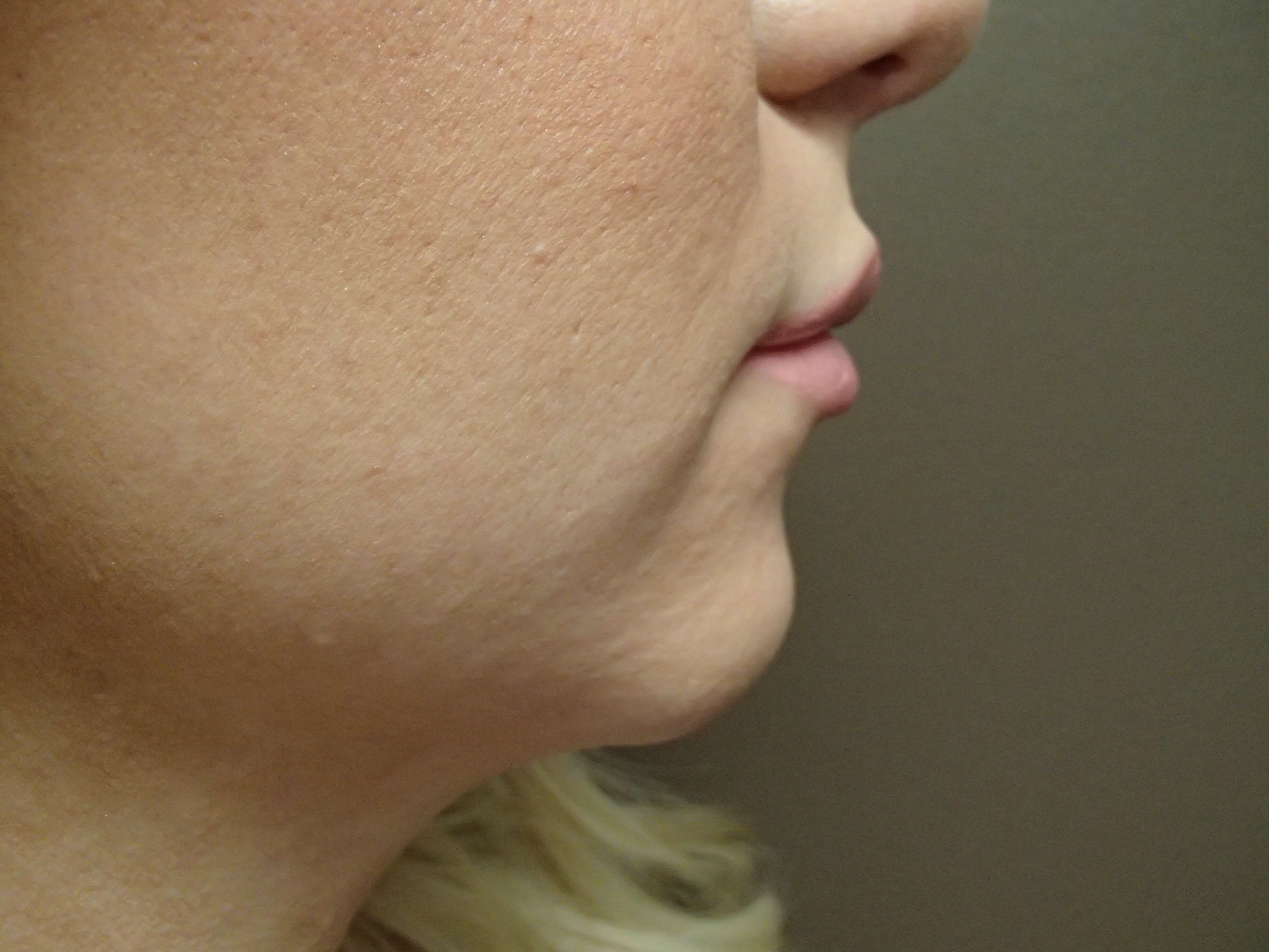 Chin Augmentation After