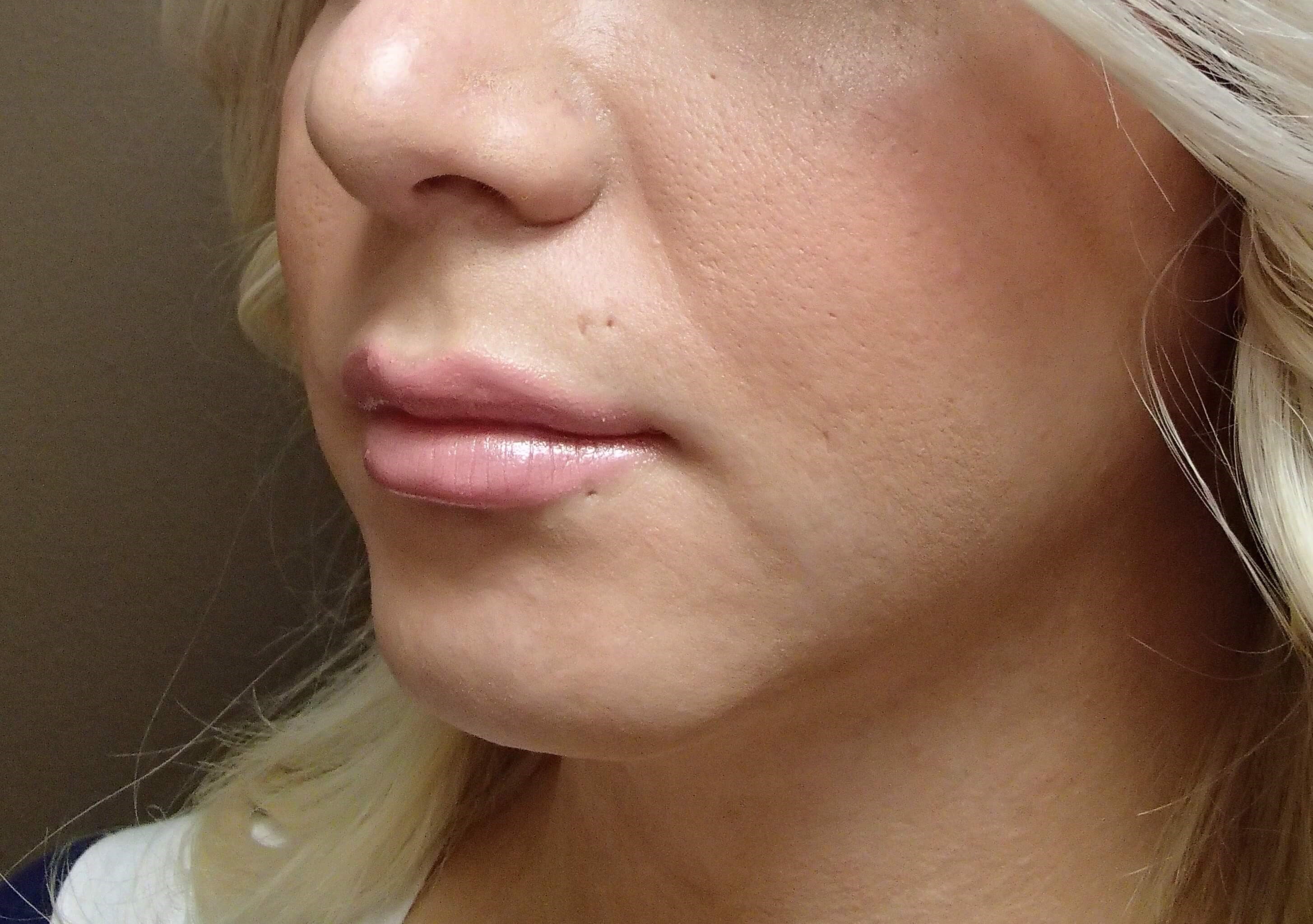 Chin Augmentation After