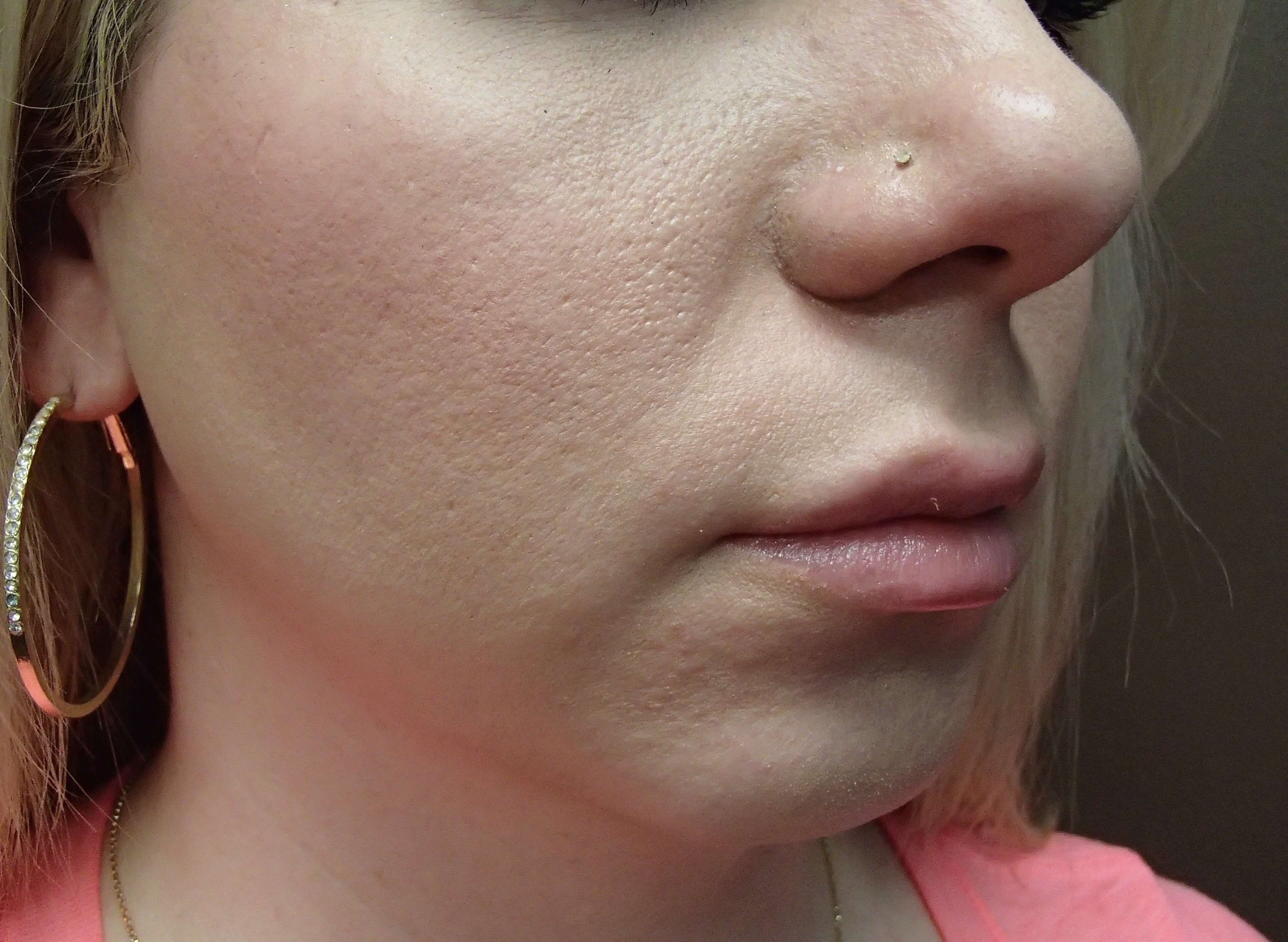 Chin Augmentation Before