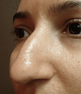 Rhinoplasty Before