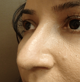Rhinoplasty After
