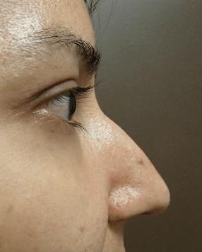Rhinoplasty Before