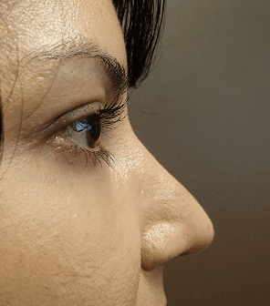 Rhinoplasty After