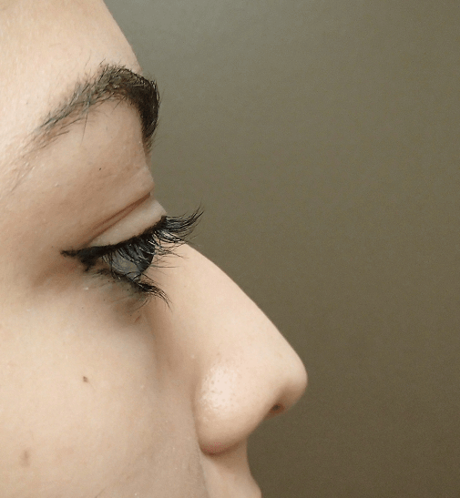 Rhinoplasty Before