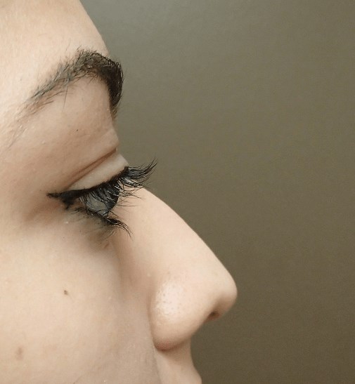 Rhinoplasty Before