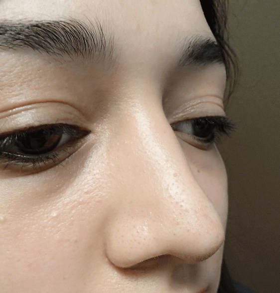 Rhinoplasty After
