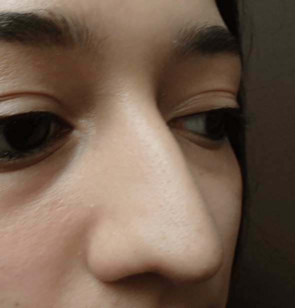 Rhinoplasty Before