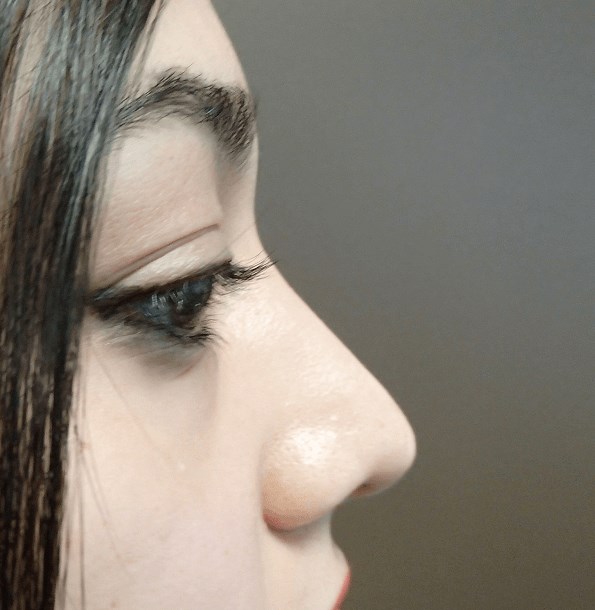 Rhinoplasty After
