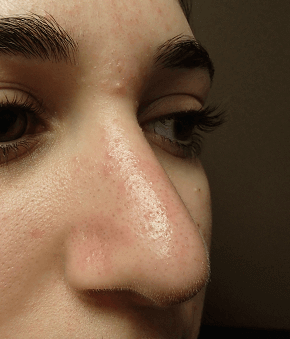 Rhinoplasty After