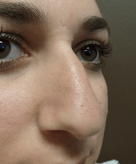 Rhinoplasty Before