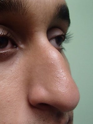 Rhinoplasty Before