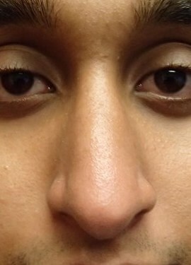 Rhinoplasty After