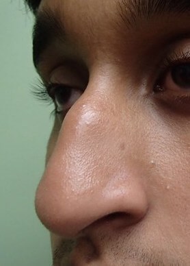 Rhinoplasty Before