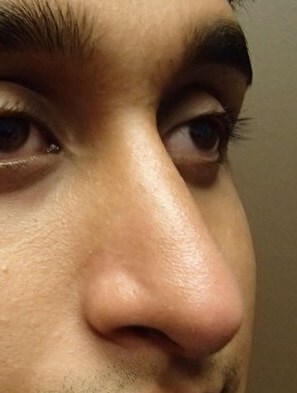 Rhinoplasty After