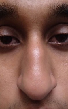 Rhinoplasty Before