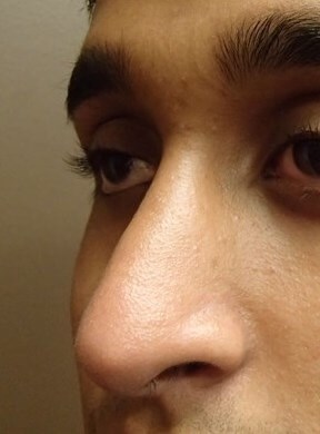 Rhinoplasty After