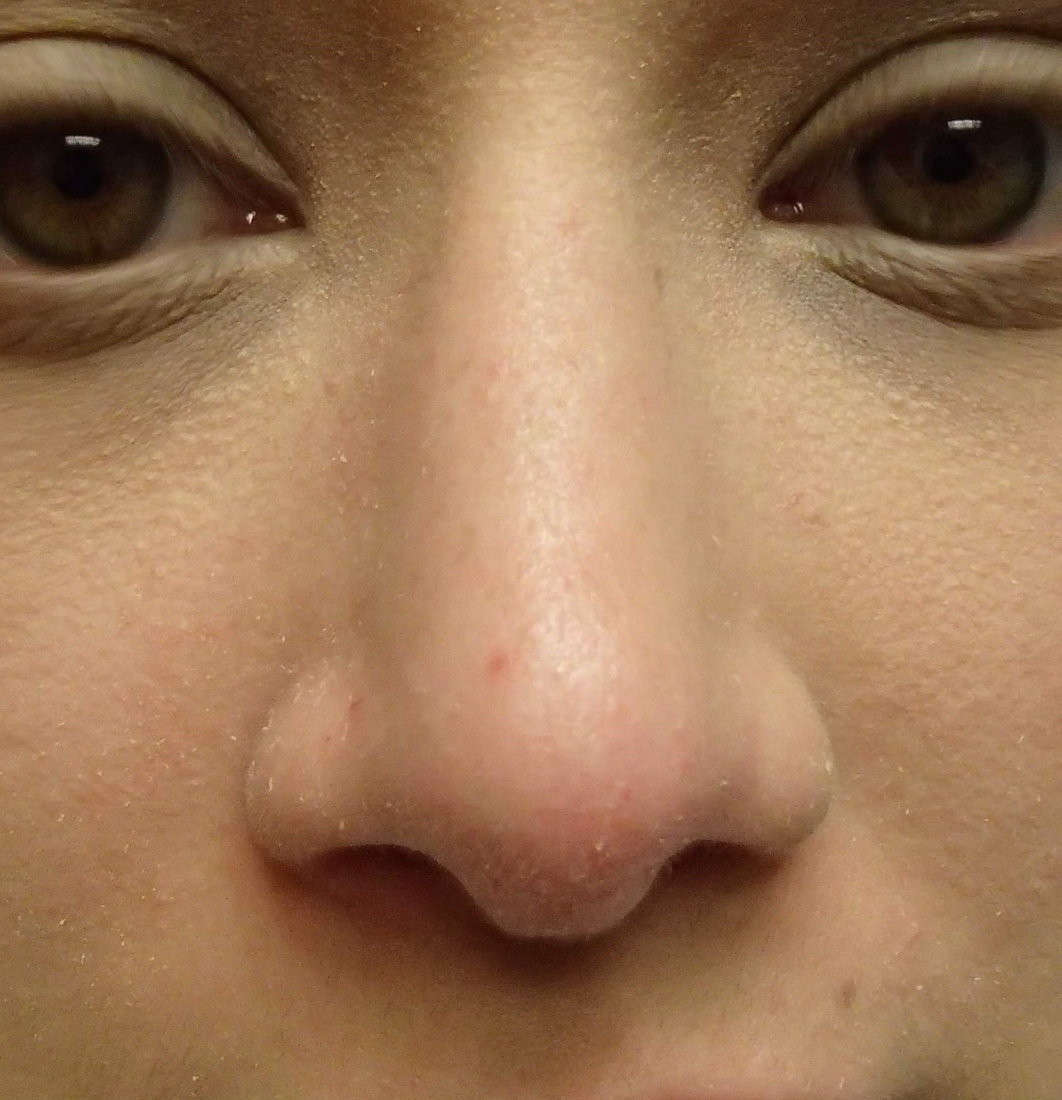 Rhinoplasty (nose job) After