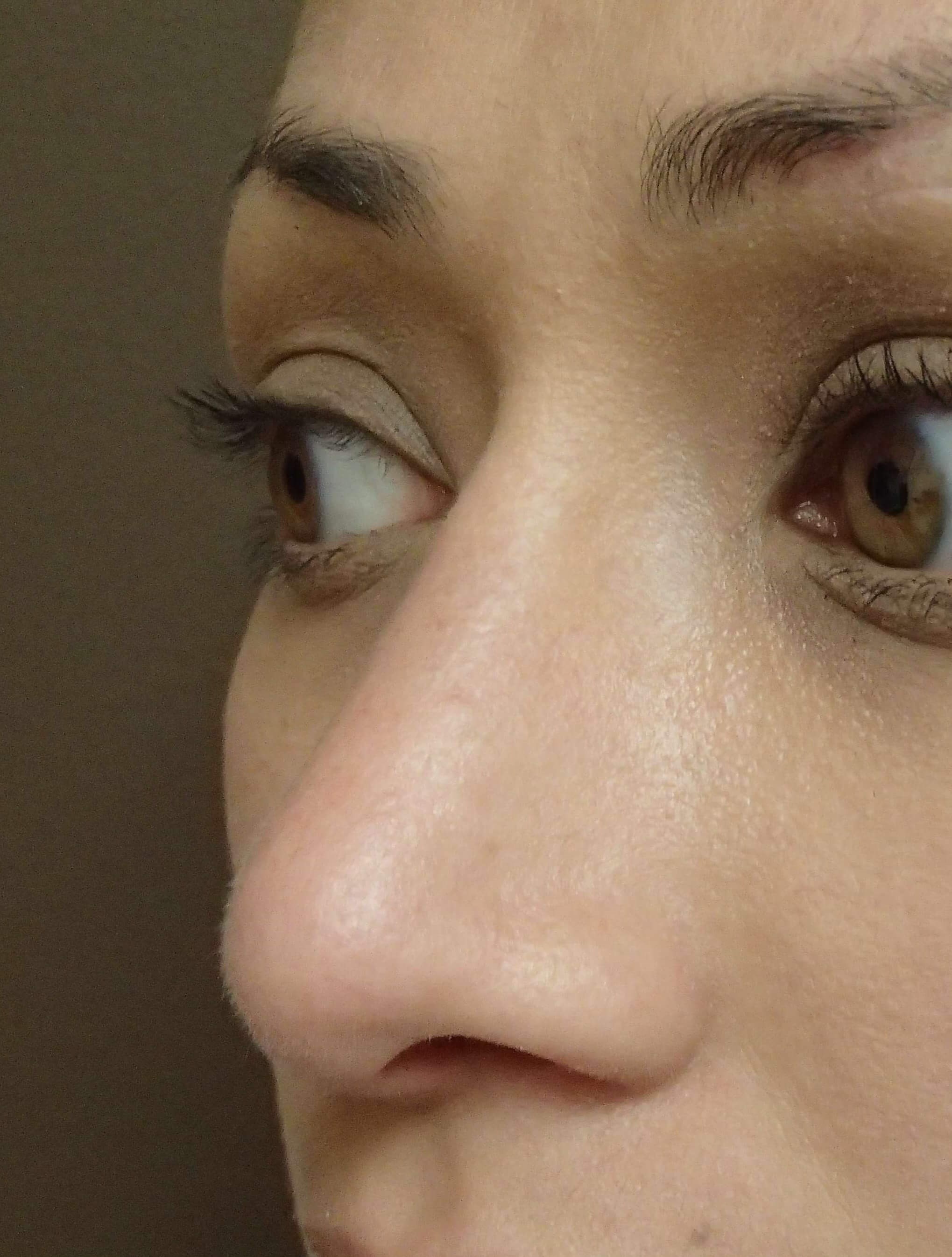 Rhinoplasty (nose job) After