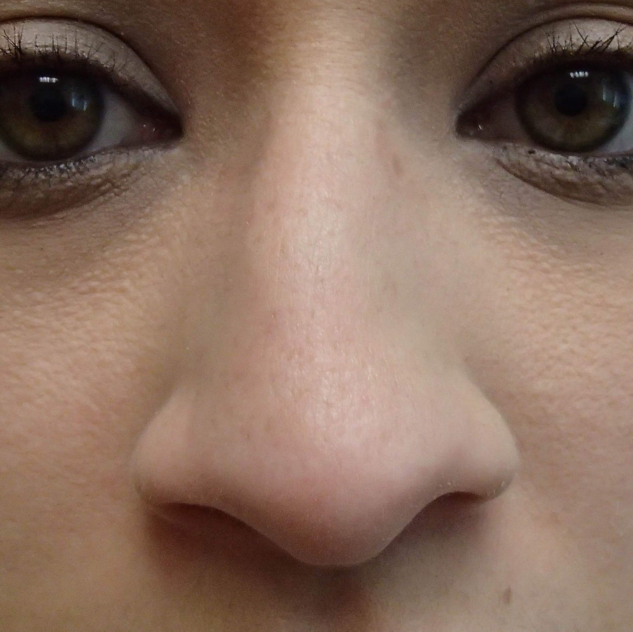 Rhinoplasty (nose job) Before