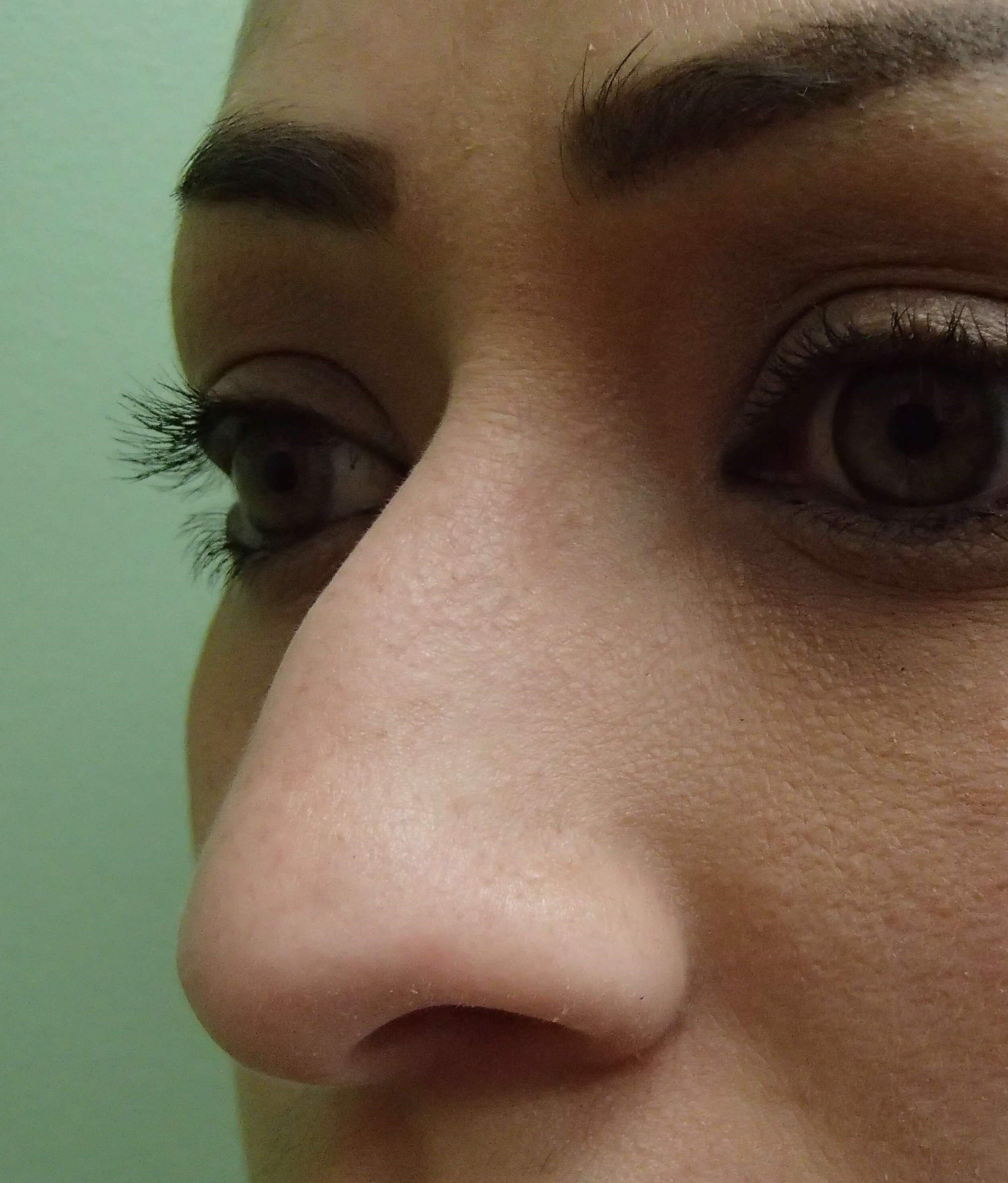 Rhinoplasty (nose job) Before