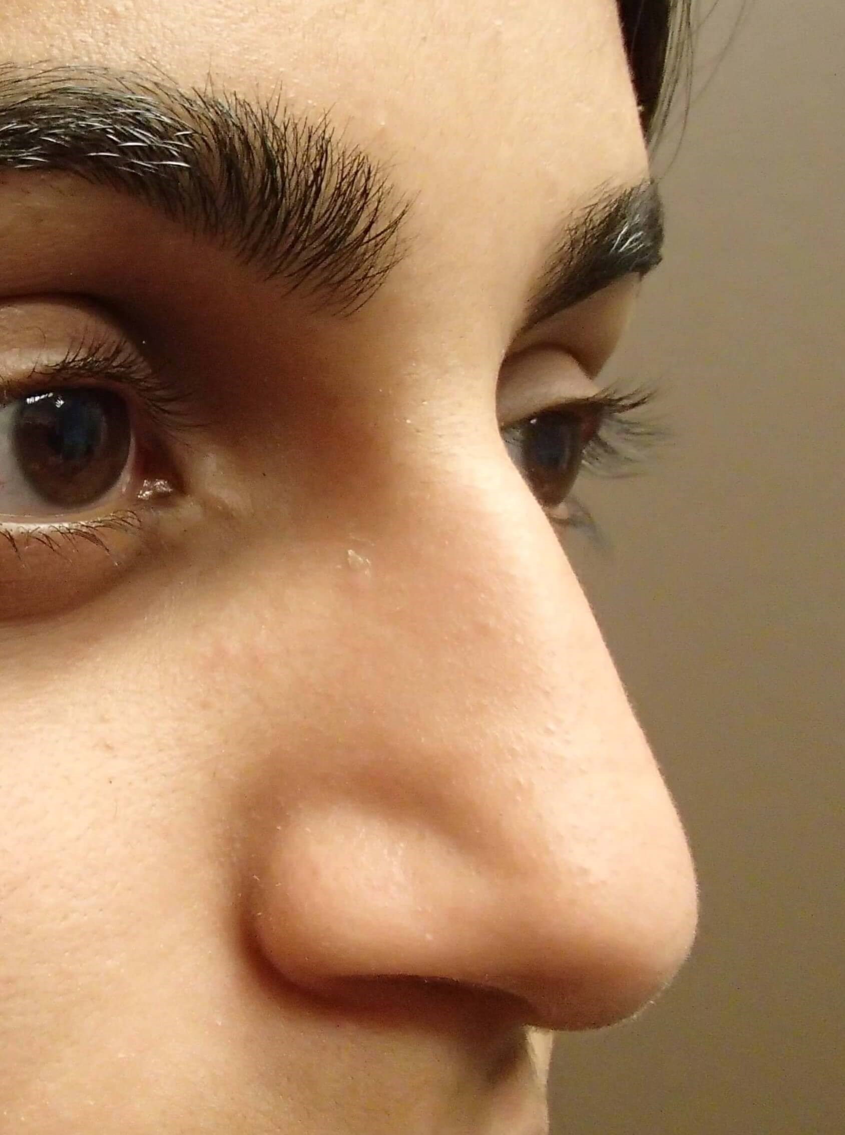 Rhinoplasty (nose job) Before